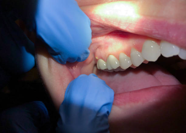 Best Emergency Treatment for Dental Infections or Abscesses in Monroe, GA