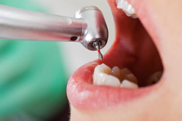 Best Emergency Tooth Extraction in Monroe, GA
